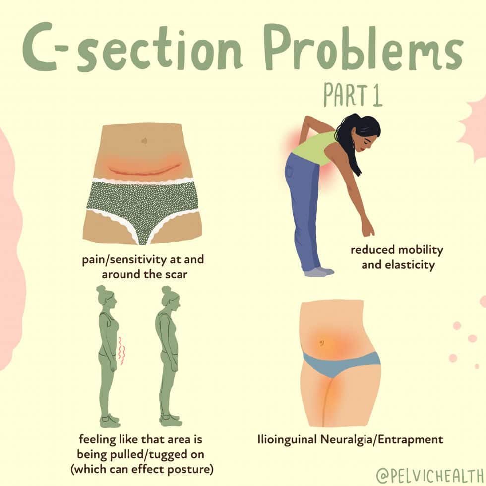 How To Clean A C Section Incision Flatdisk24